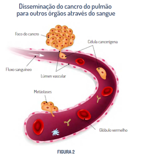 Imagem disseminação cancro pulmão para outros órgãos atraves do sangue
