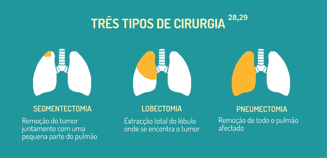 Imagem com os três tipos de cirurgia